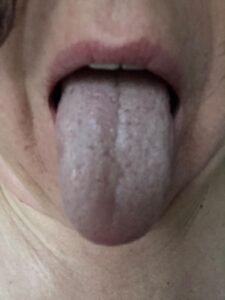 Day 3 — Deeper Layers Surface: Vata Imbalance (Bluish Tinge)